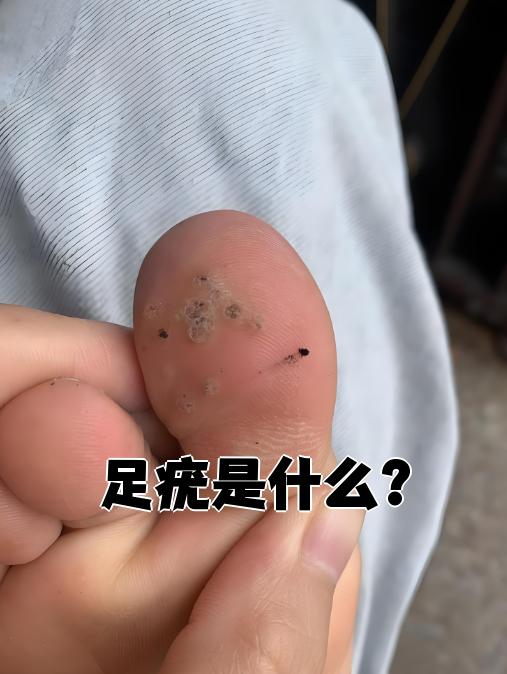 跖疣什么原因造成的