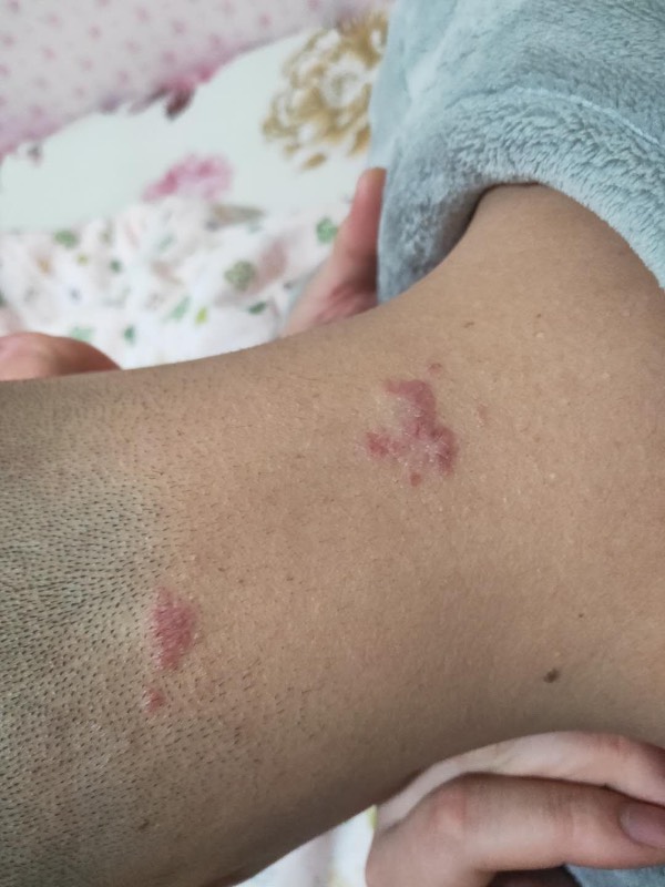 脖子痒是艾滋病的症状吗