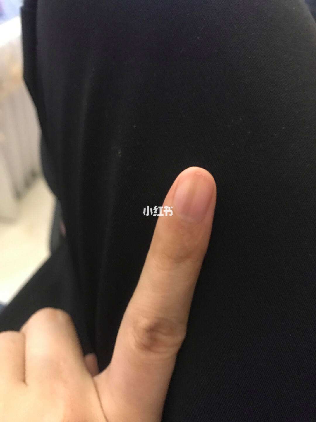 手指甲上有黑色竖纹怎么回事