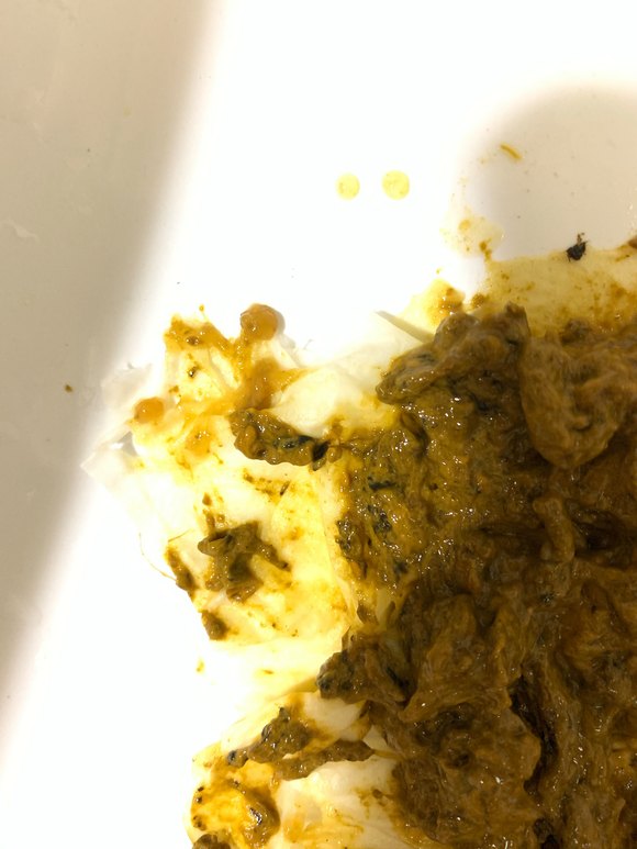 大便有粘液是什么原因?