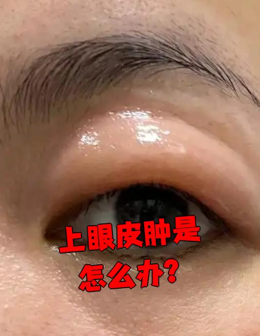 上眼皮红肿是热敷还是冷敷