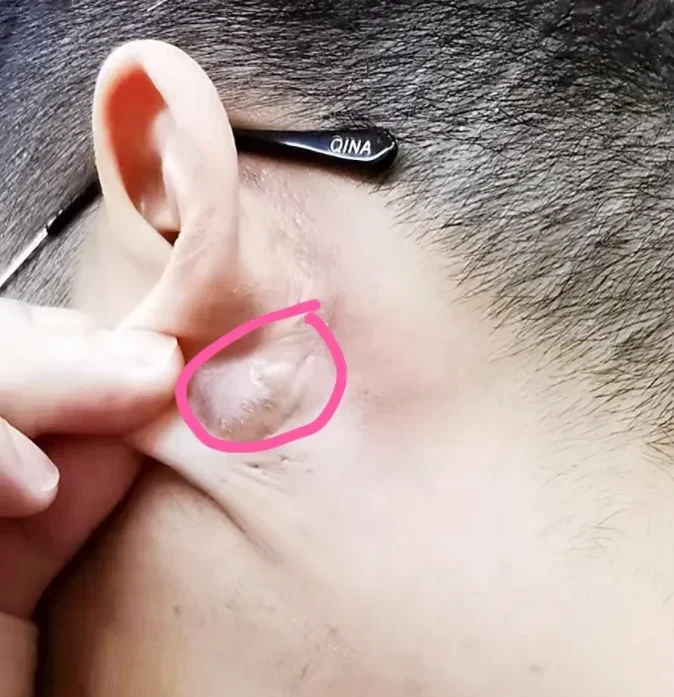 耳朵后面有硬包不痛不痒