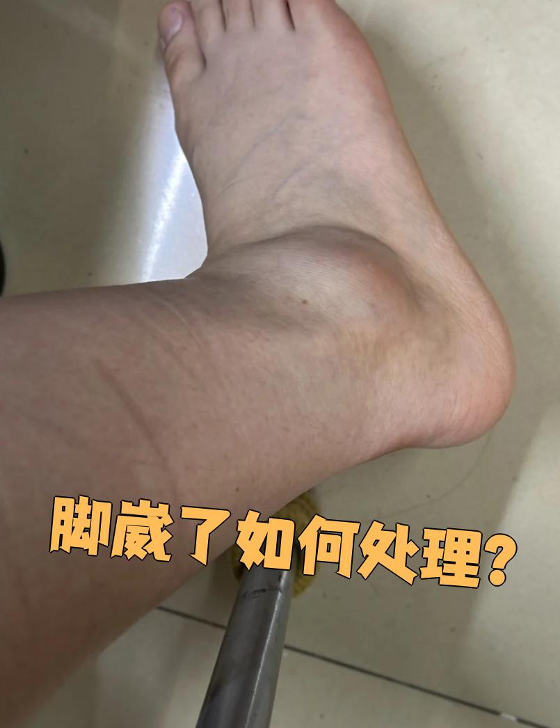 几小时前下楼梯脚崴了