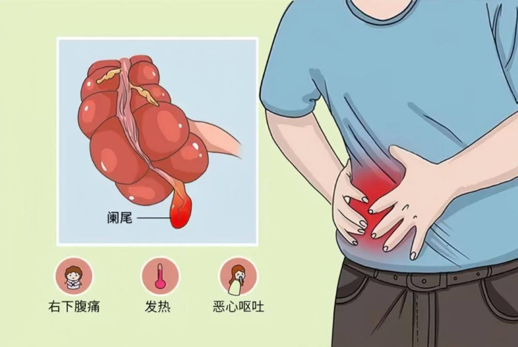 阑尾炎在哪边