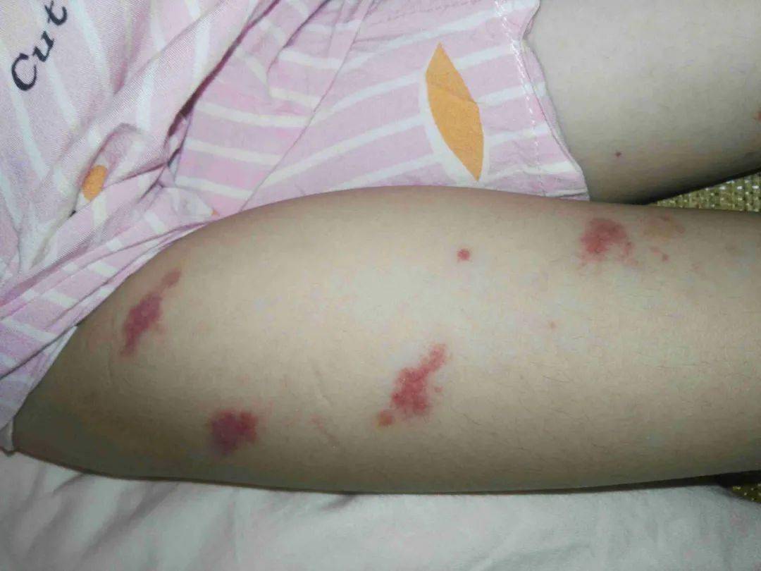 腿上有红斑