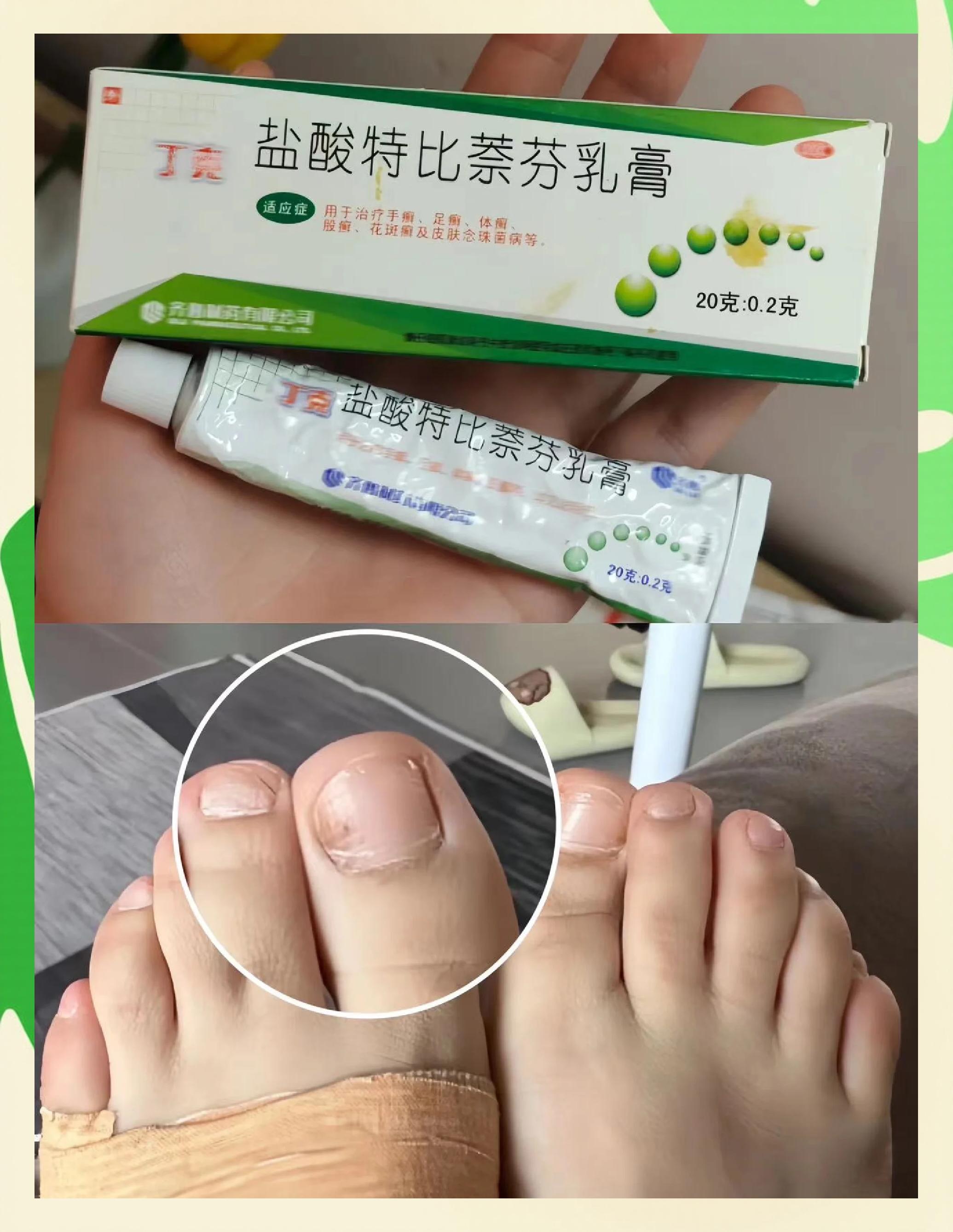 灰指甲的治疗偏方有哪些?