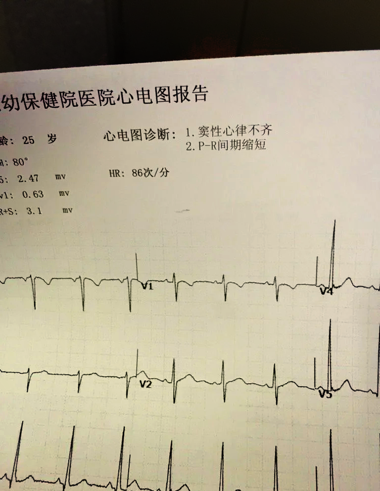 窦性心律t波异常严重吗