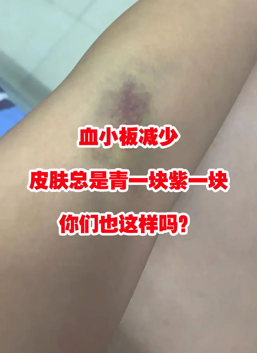 血小板减少是什么情况