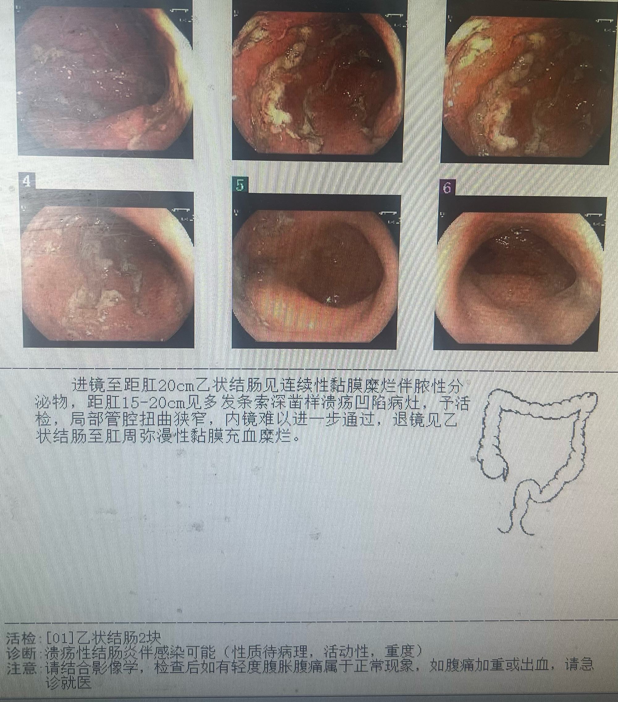 结肠炎严重吗?