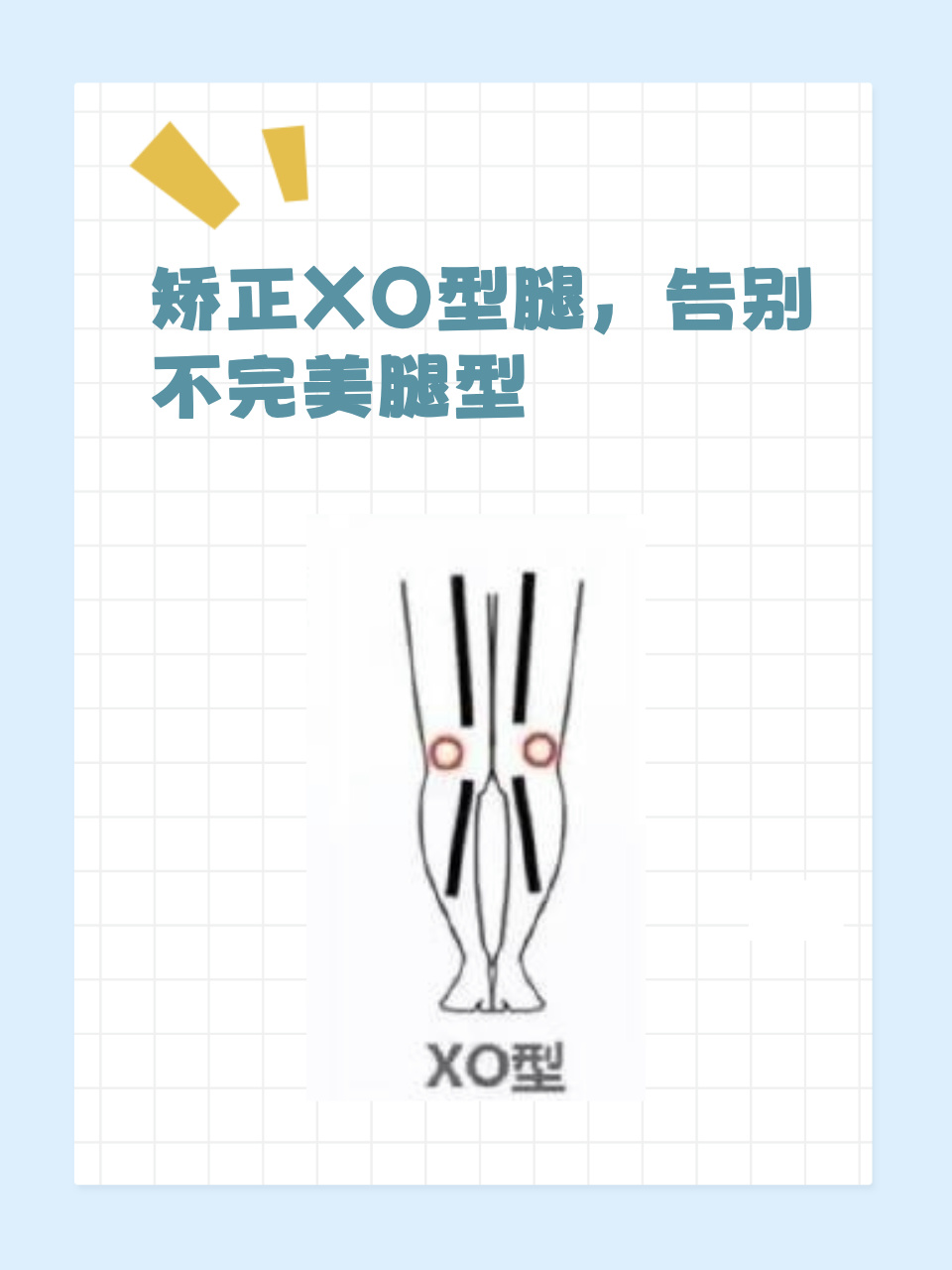 怎么矫正X型腿