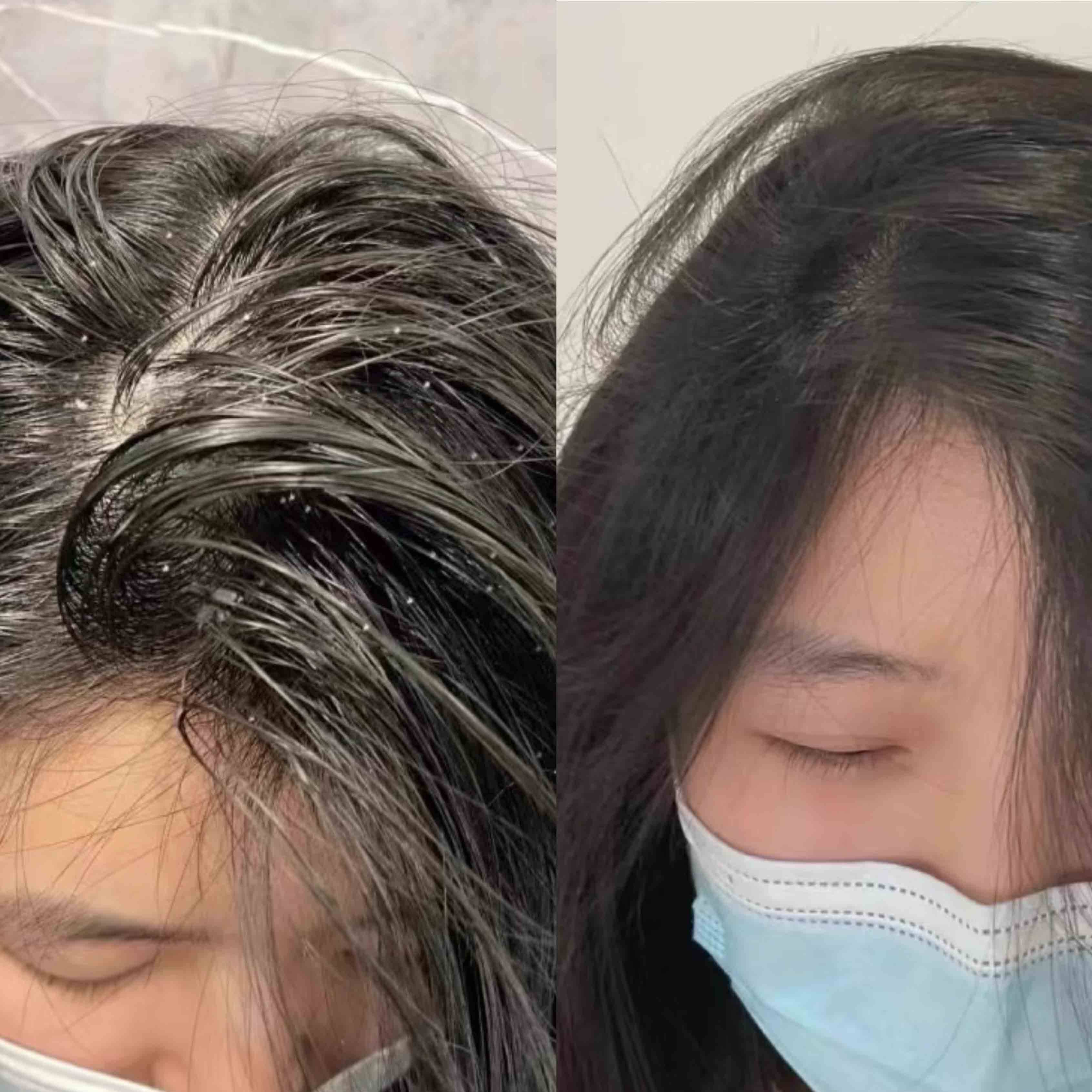 头皮毛囊炎用什么洗头