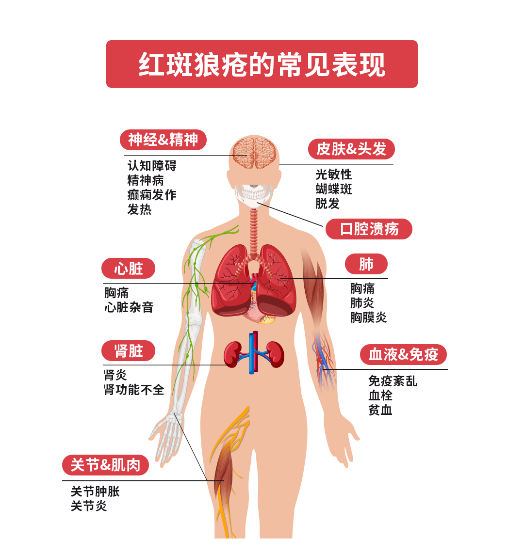 红斑狼疮是怎么引起的?