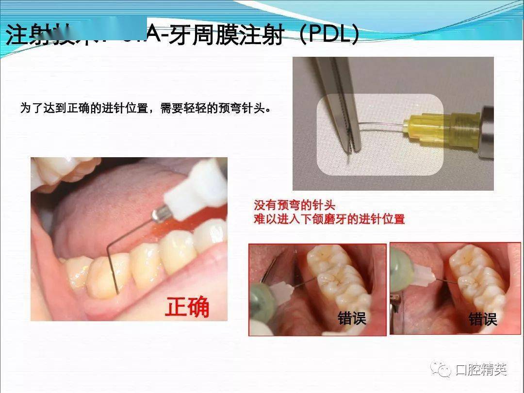 下牙槽神经阻滞麻醉进针点