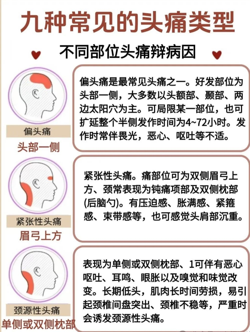 偏头痛怎样缓解