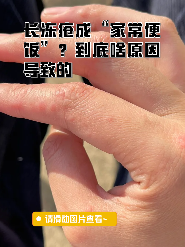 手上生冻疮怎么治疗