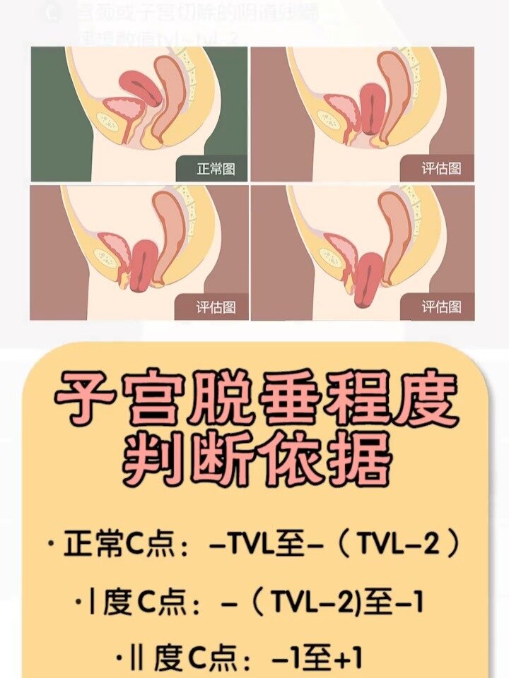 什么是子宫脱垂?