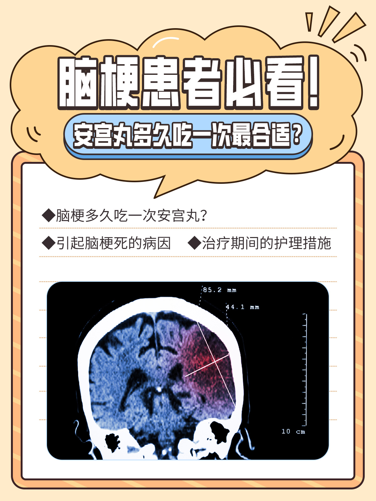 脑梗死能活多久?