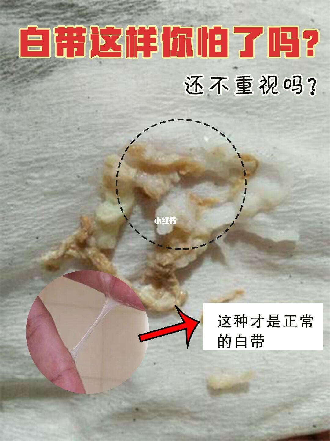 用了消糜泡腾片,排出了东西