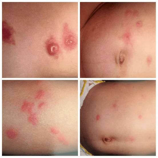 虫咬皮炎能自愈吗