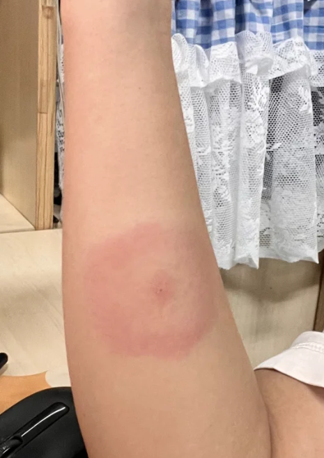 被虫子咬了红肿怎么办