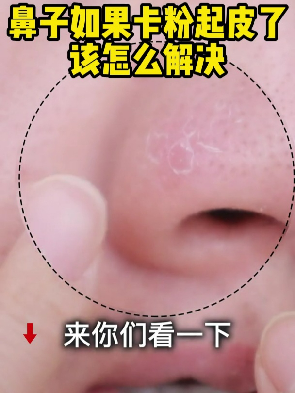 鼻子发干怎么回事?