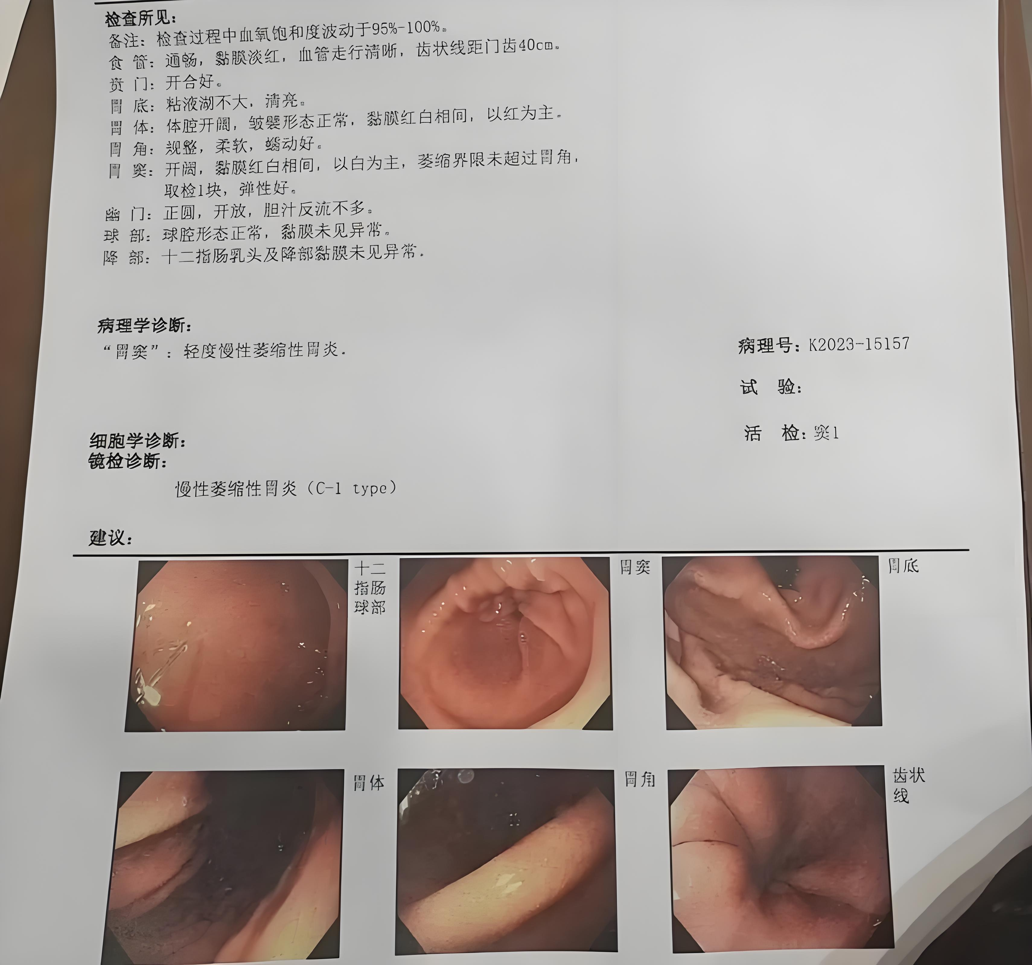 慢性萎缩性胃炎伴糜烂严重吗