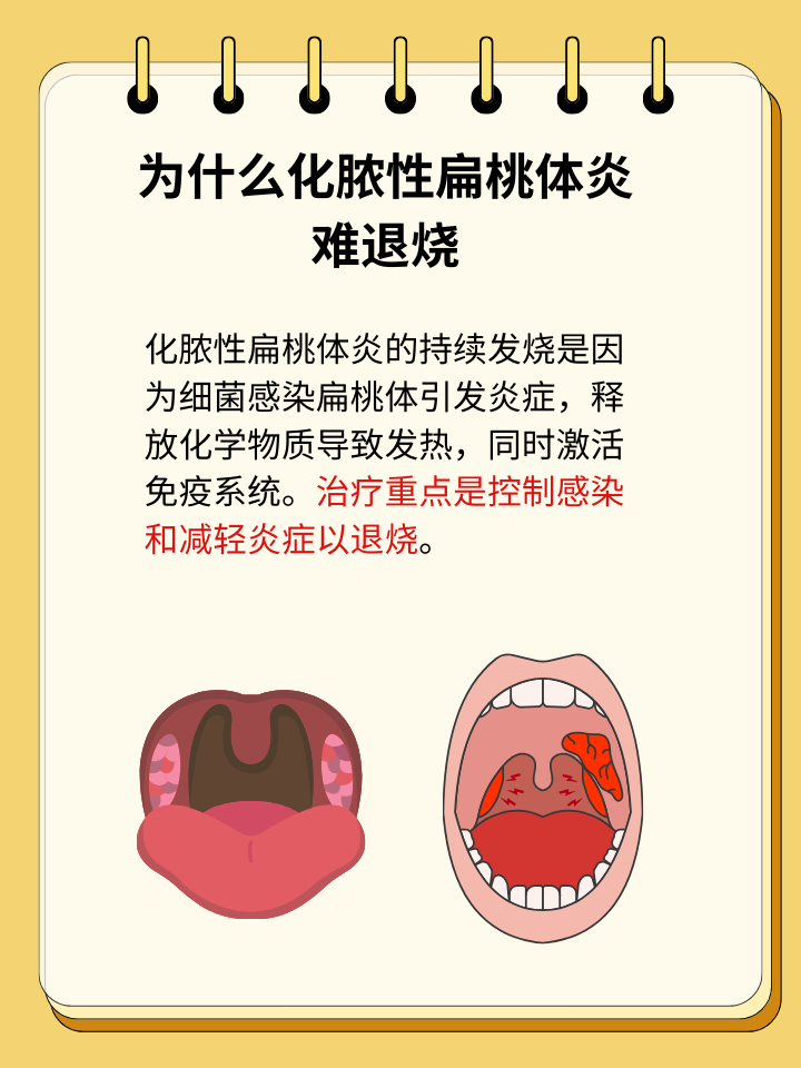 急性化脓性扁桃体炎多久好