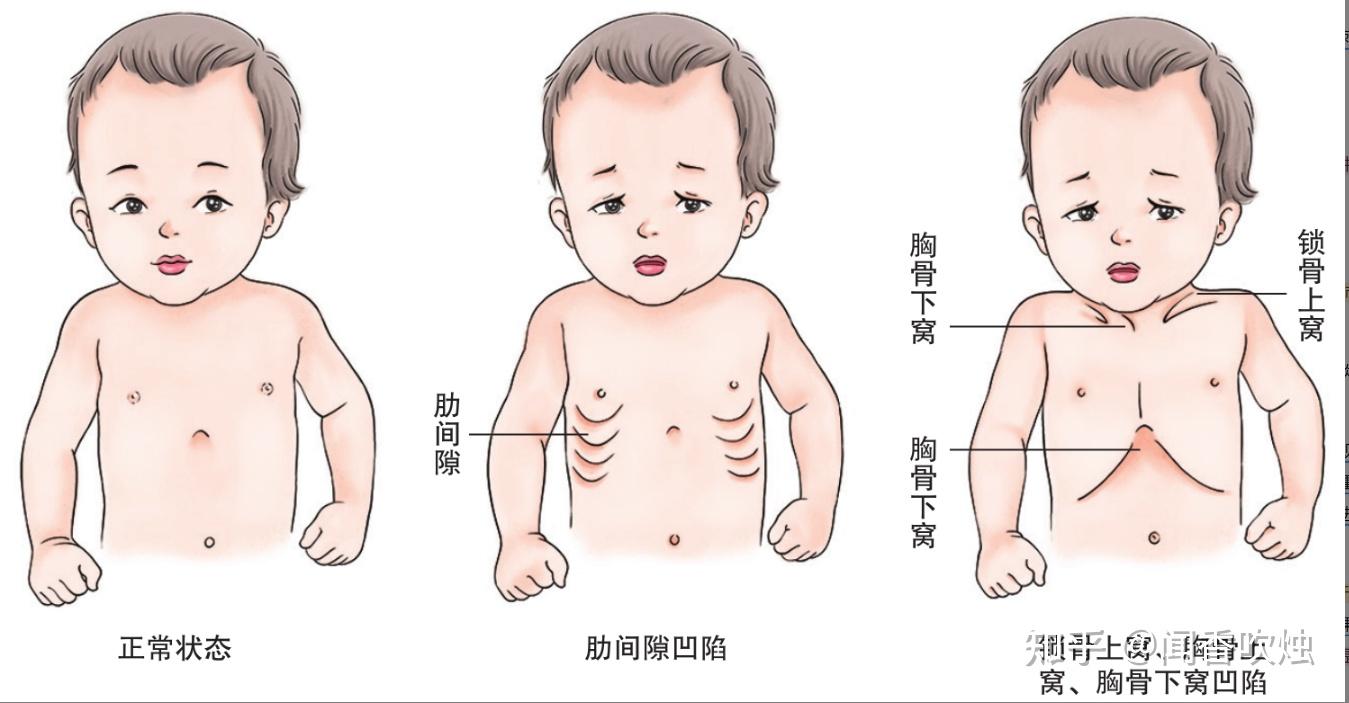 肺炎支原体感染