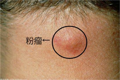 粉瘤的危害性有多大