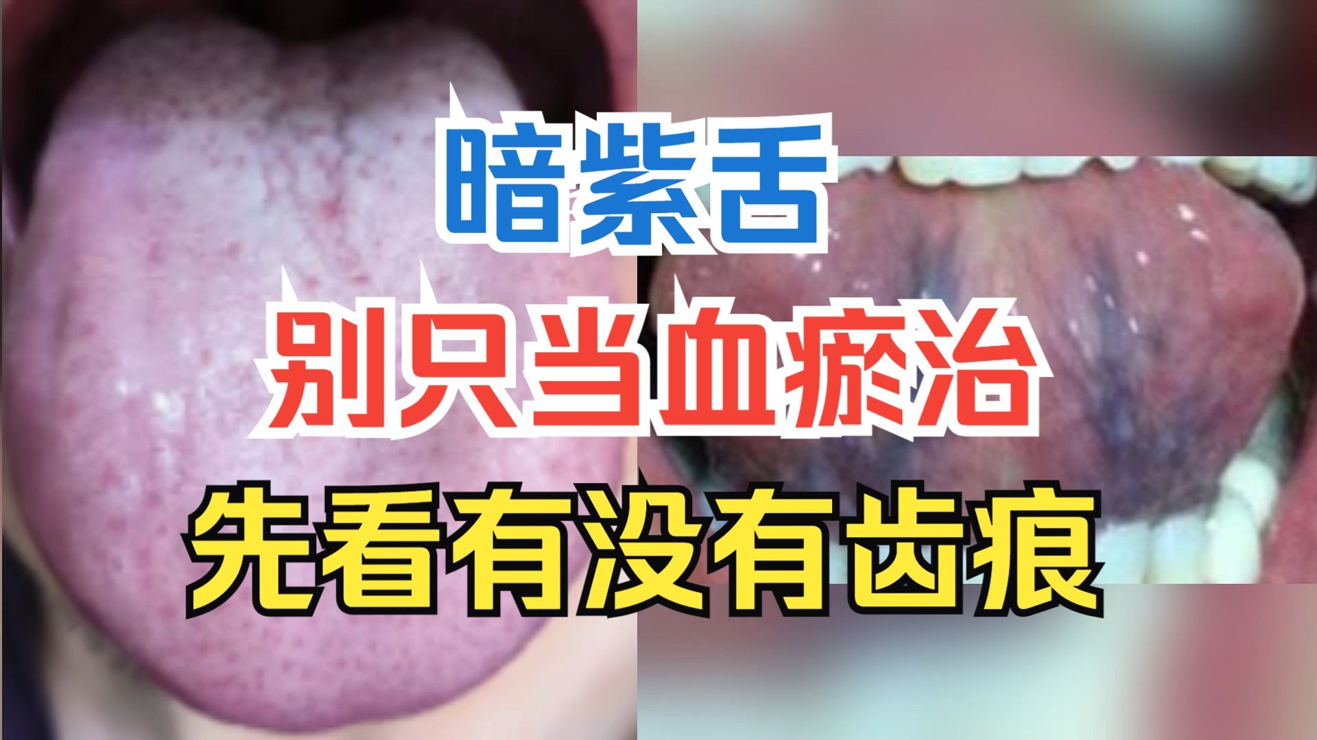 舌头发紫是怎么回事?