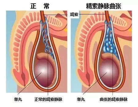 精索静脉曲张手术要多少费用