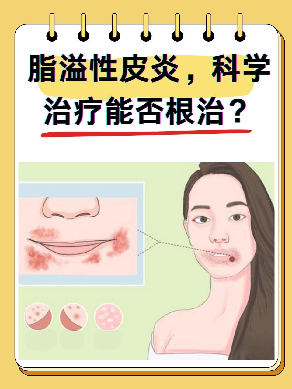 脂溢性皮炎会自己好吗?