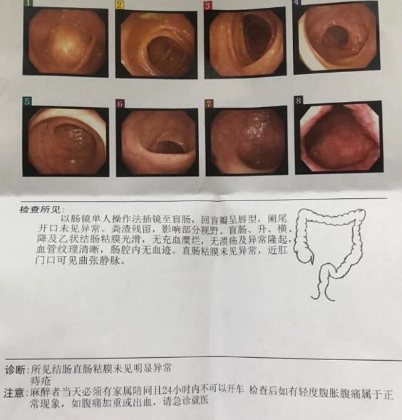 肛门处有一小块赘肉,不疼不痒