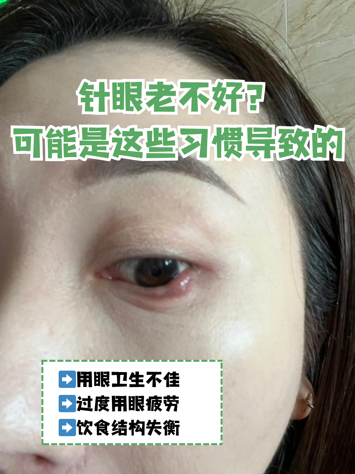 眼睛长长针眼怎么办?