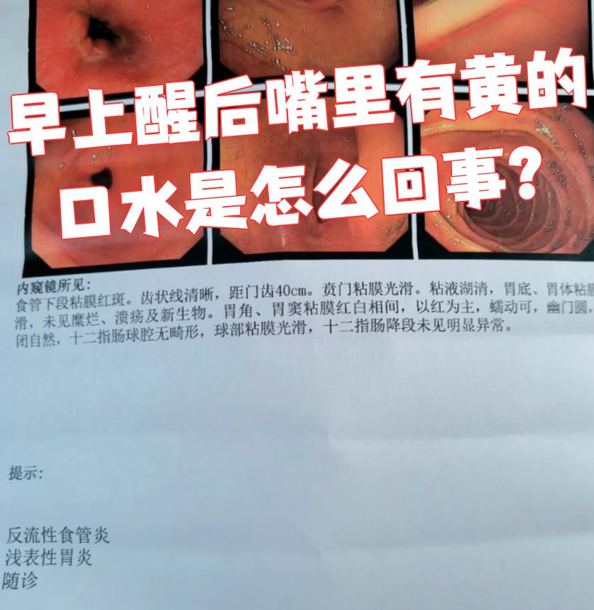 反流性食管炎早期症状