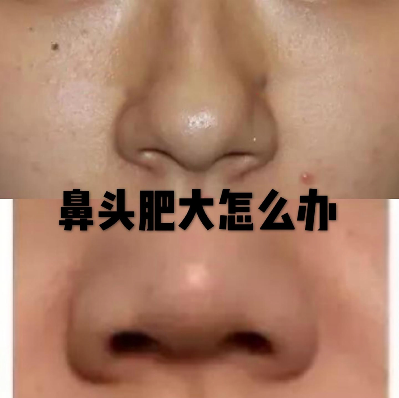 鼻头肥大鼻翼厚怎么办