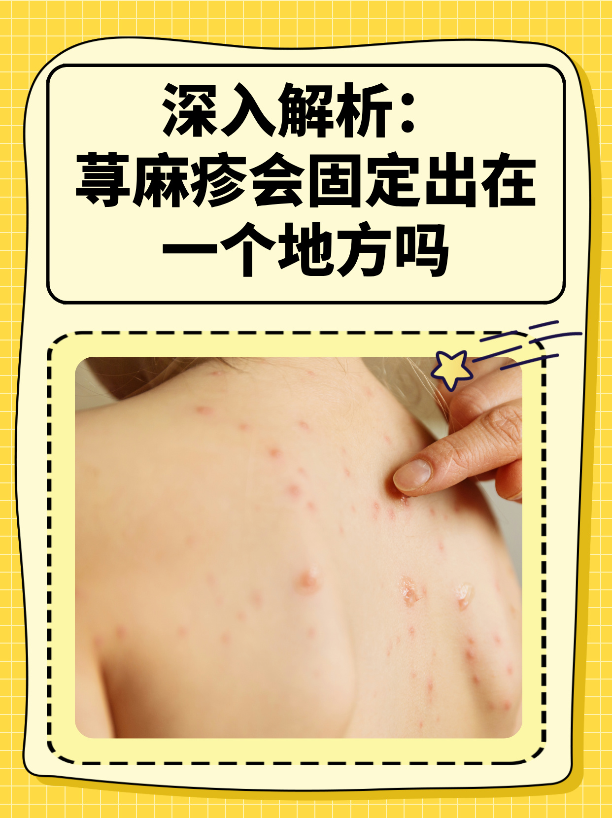 急性荨麻疹怎样止痒
