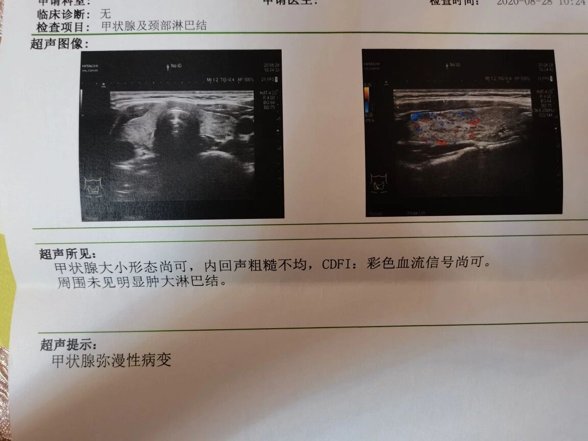 甲状腺弥漫性病变是什么意思?