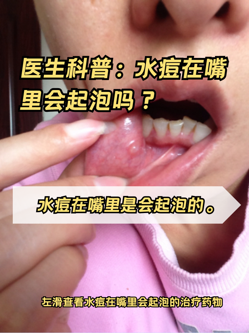 小孩嘴里面起泡怎么办