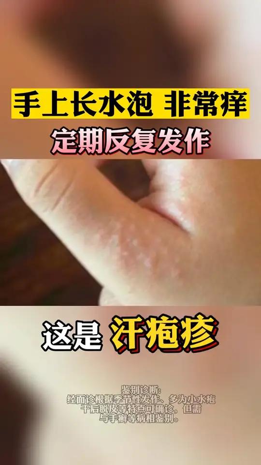 手上起小水泡