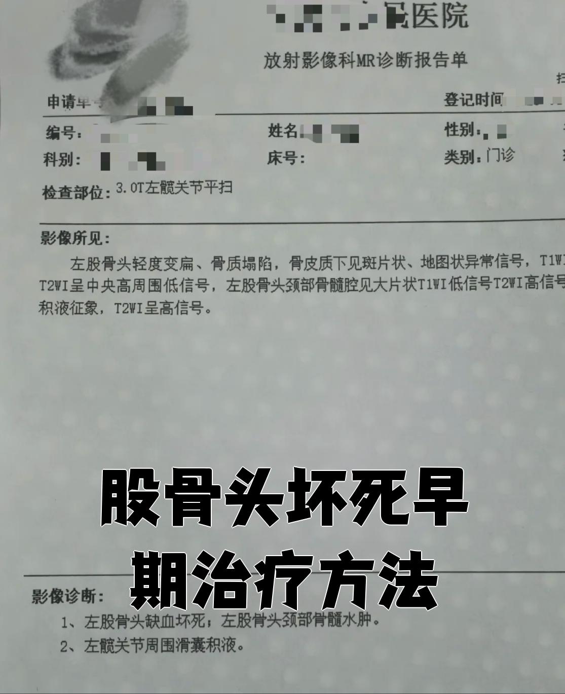 股骨头坏死治疗费用大约多少钱？