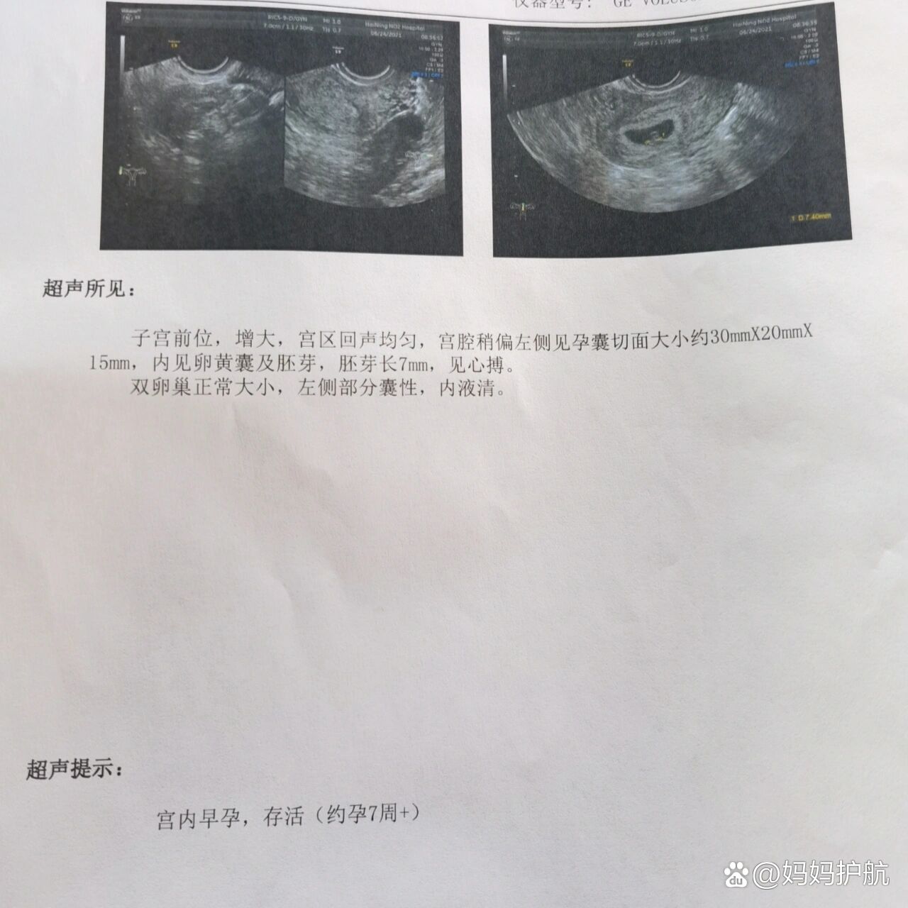 卵黄囊多久后有胎芽