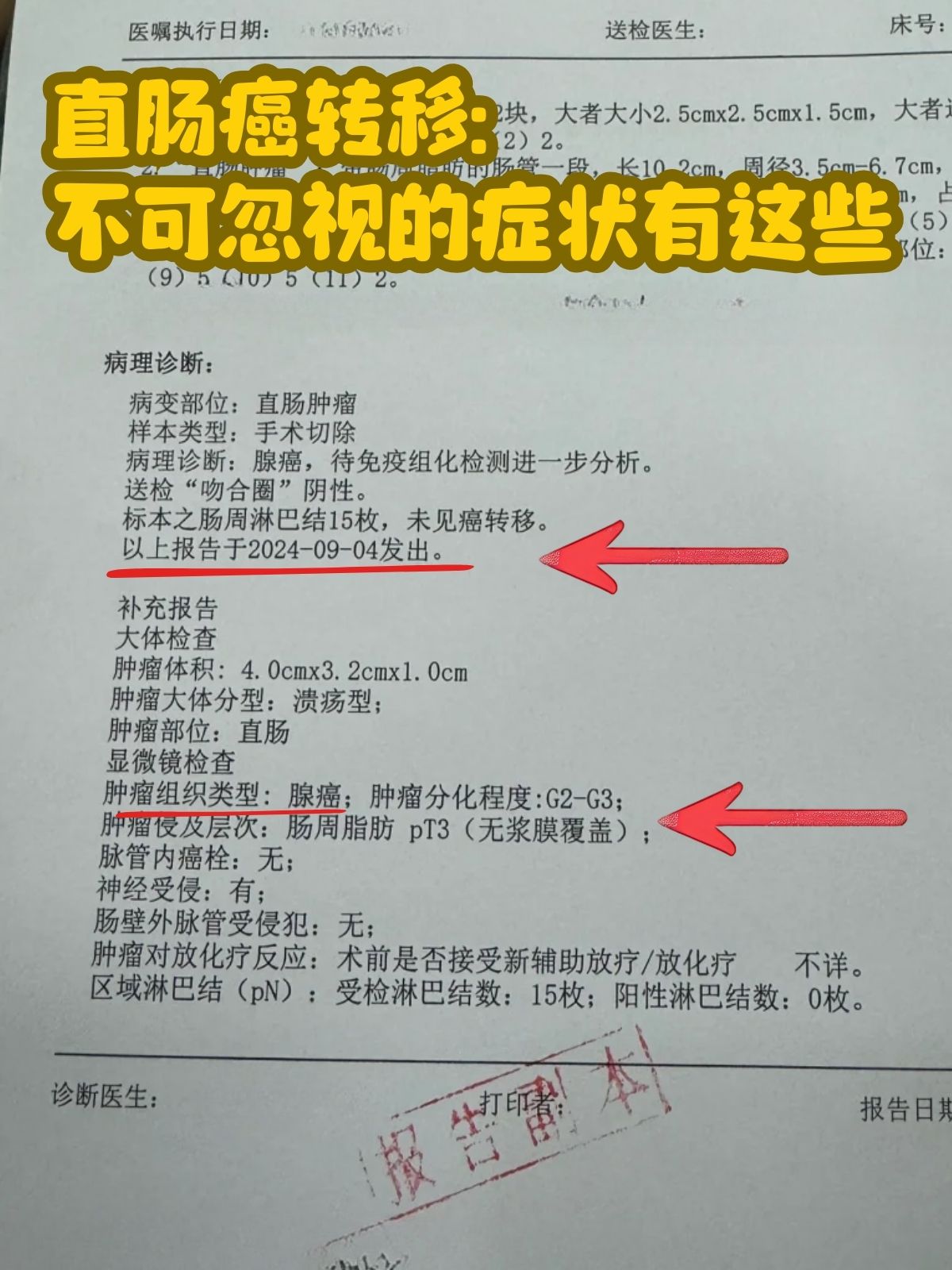 结肠癌晚期能治好吗?