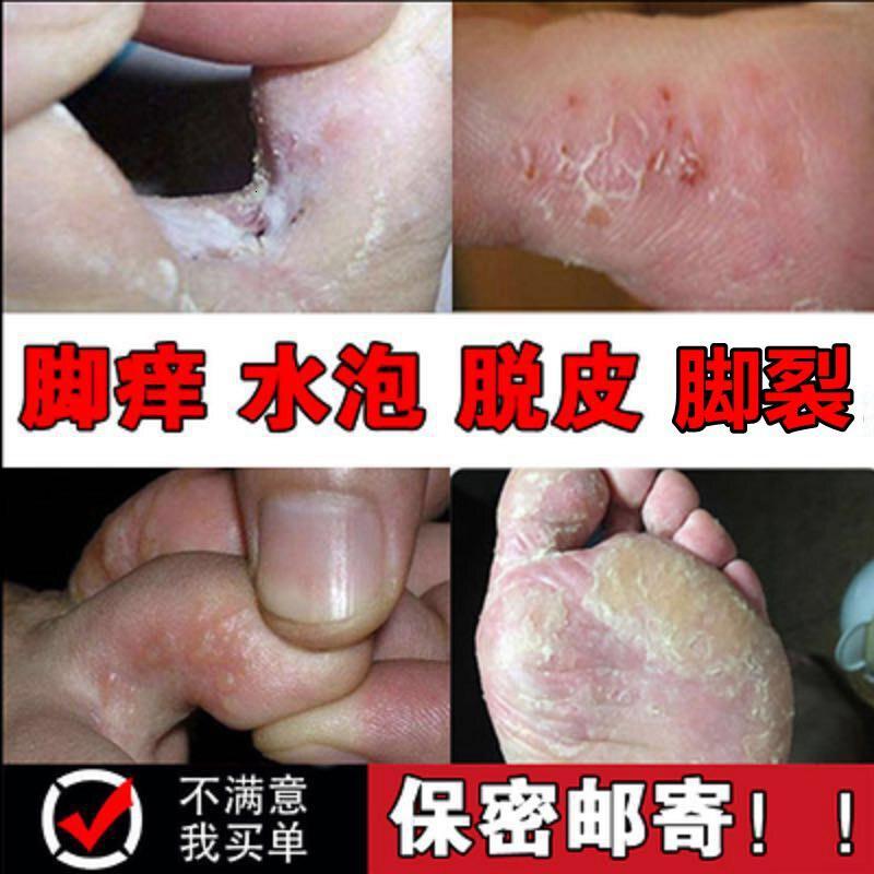 脚上起水泡痒怎么治