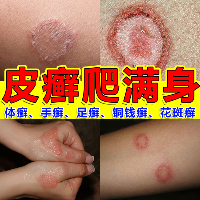 花斑癣该怎么治疗