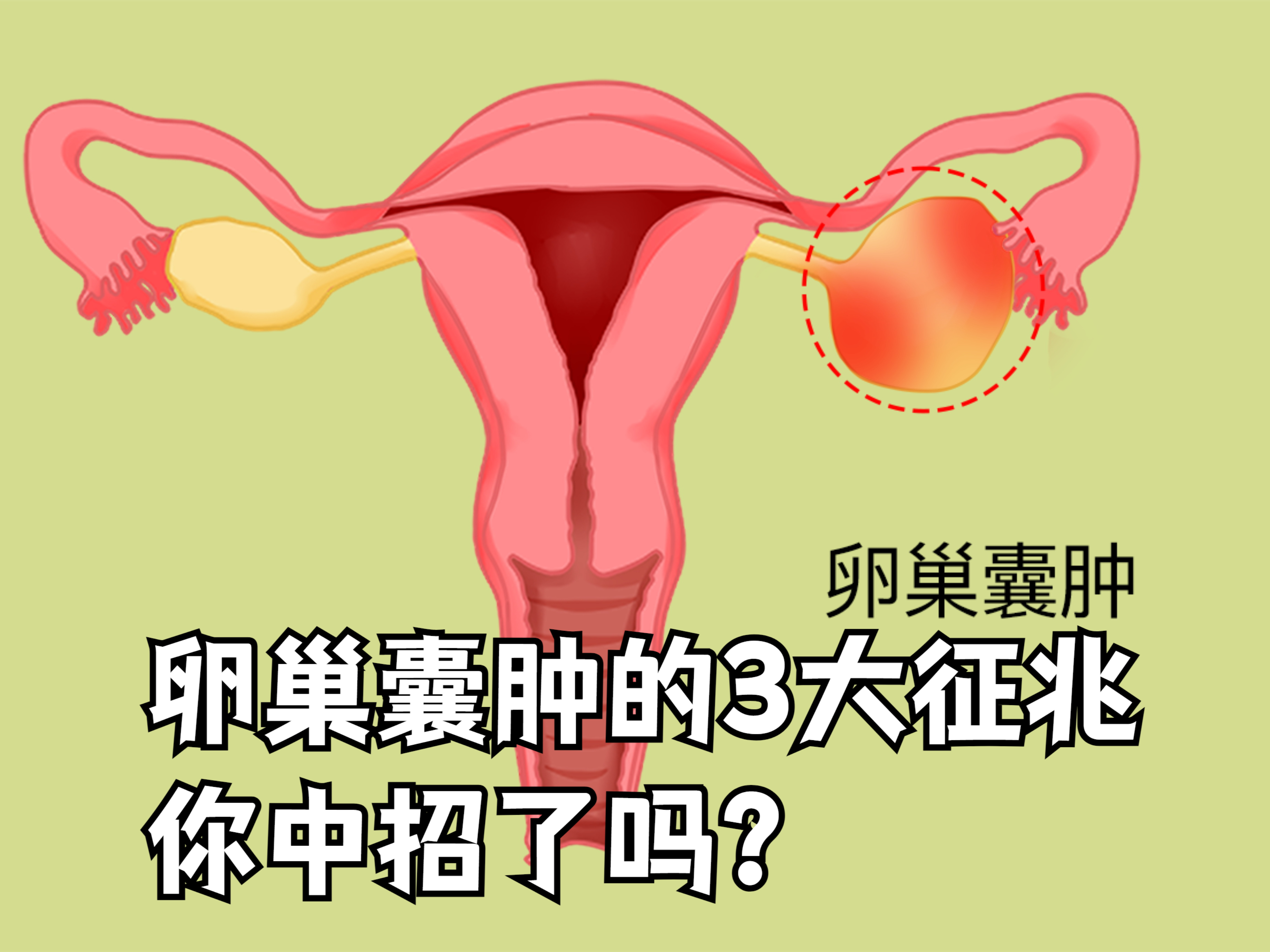 卵巢囊肿一般都有什么症状?