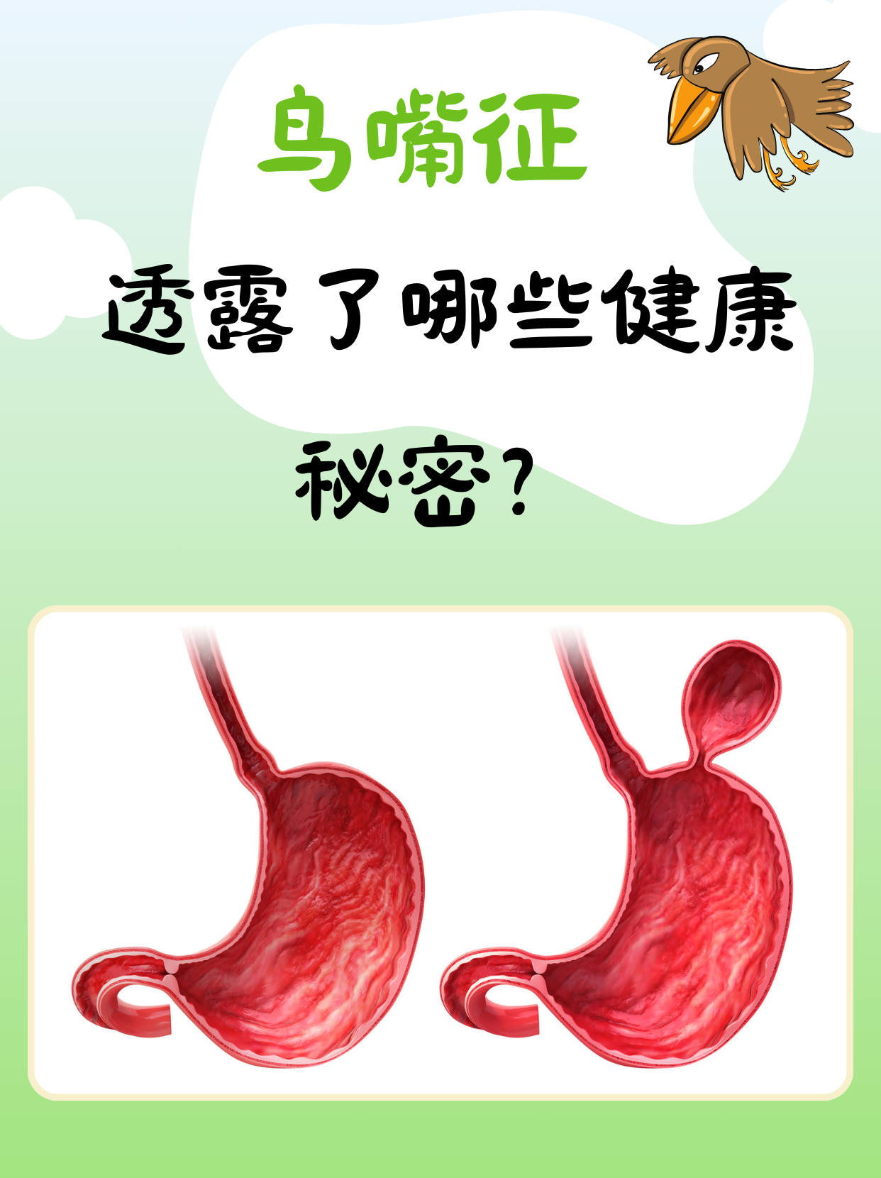 什么是食管贲门失弛缓症