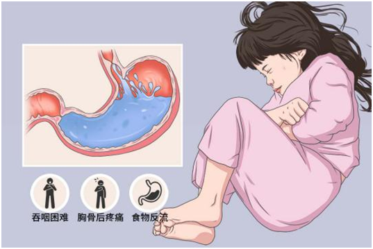 什么是食管贲门失弛缓症