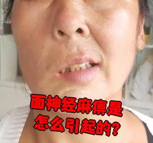 面神经麻痹是什么