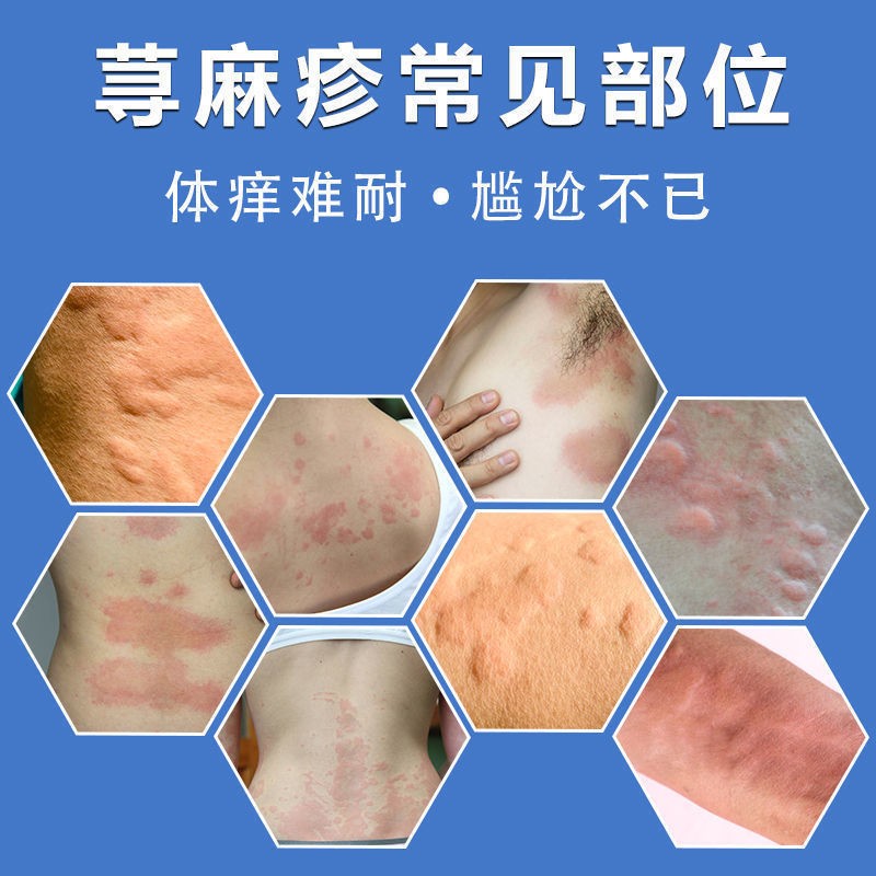 荨麻疹用什么药